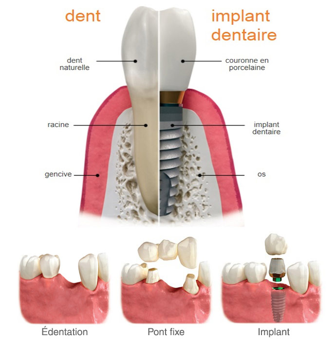 Édentation, pont fixe ou implant