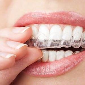 Blanchiment des dents à l’aide de gouttières