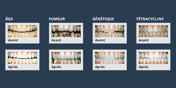 Dents jaunes? Nous avons la solution.