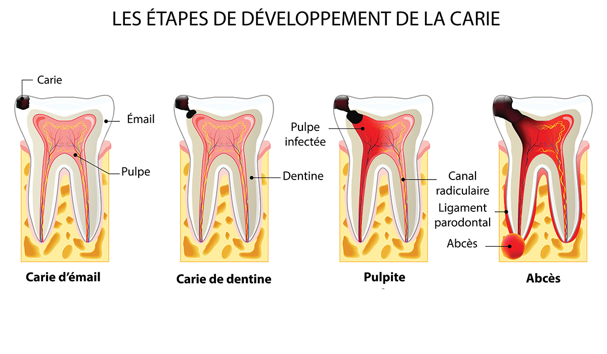 Développement de caries