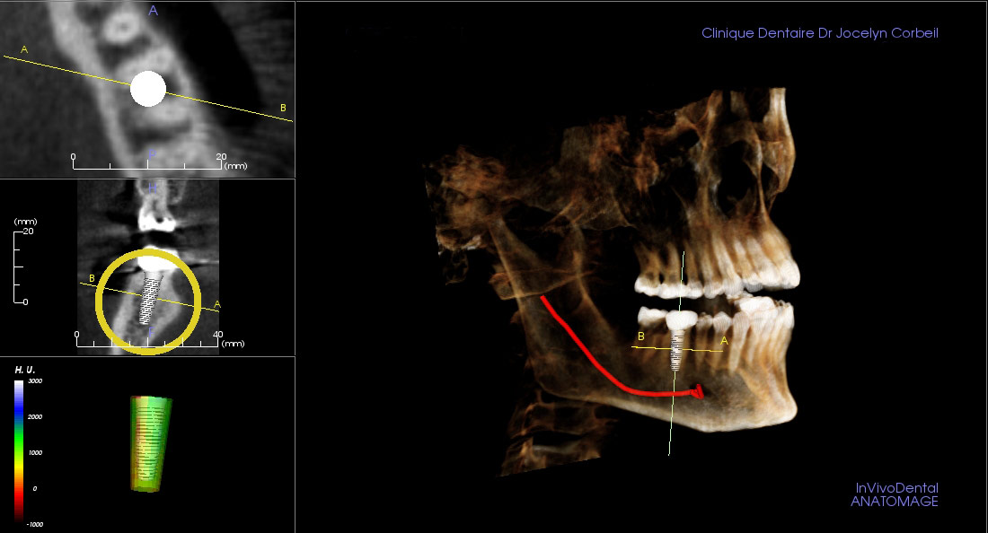 Diagnostic préparatoire en vue d'un implant
