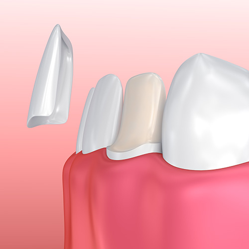 Facette de porcelaine