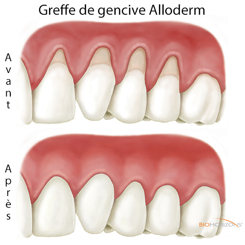 Greffe de la gencive