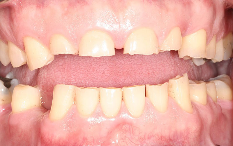 Grincement des dents