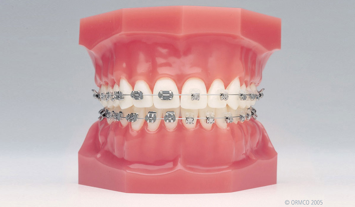 Orthodontie fixe