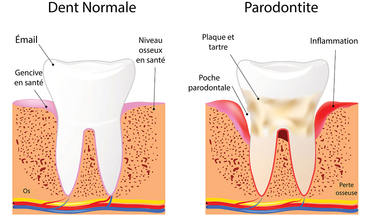 Parodontite