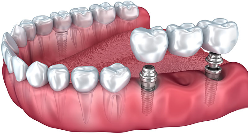 Pont fixe sur implants