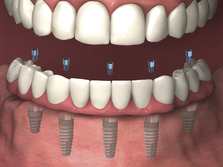 Prothèse à implants