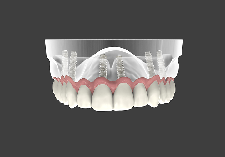 Prothèse à implants