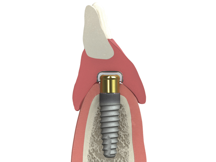 Prothèse à implants