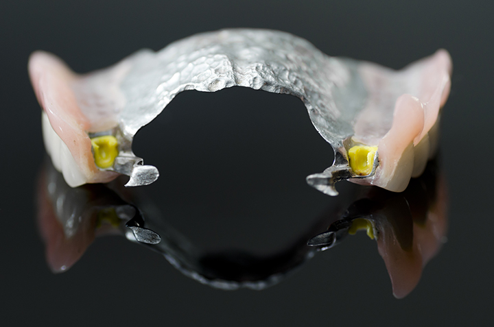 Prothèse à implants