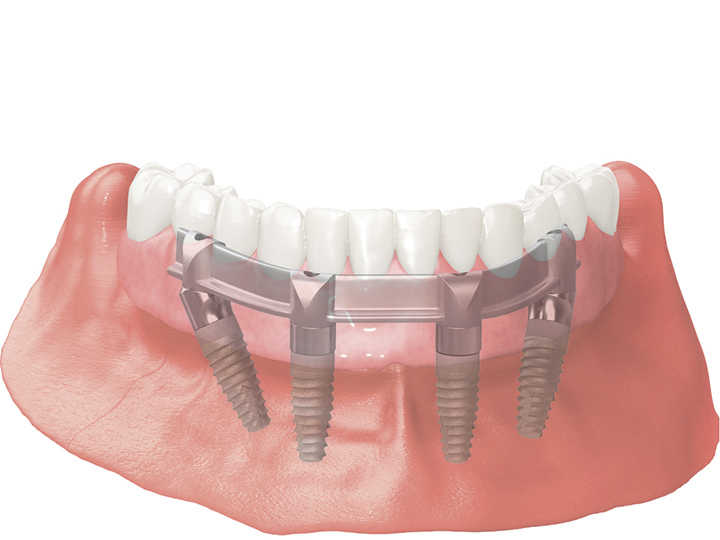 Prothèse à implants
