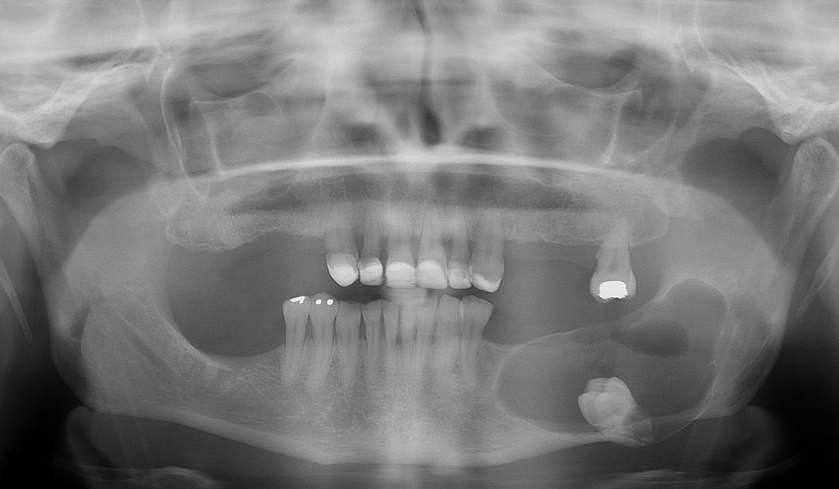 Radiographie panoramique