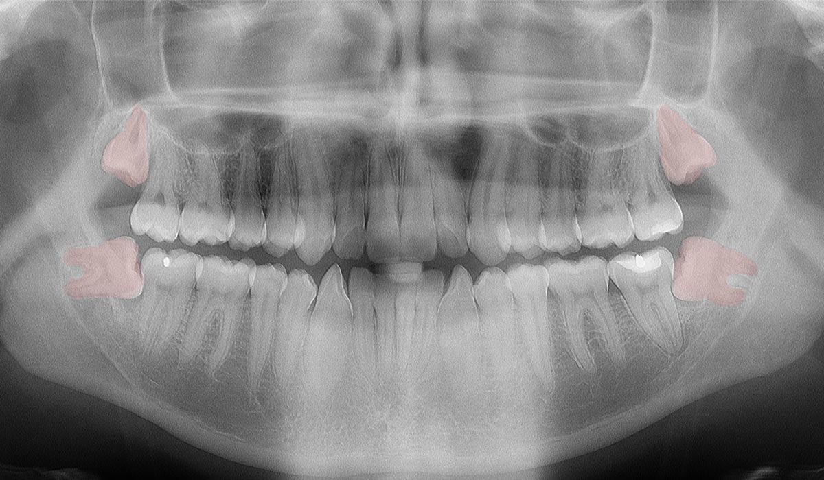 Radiographie