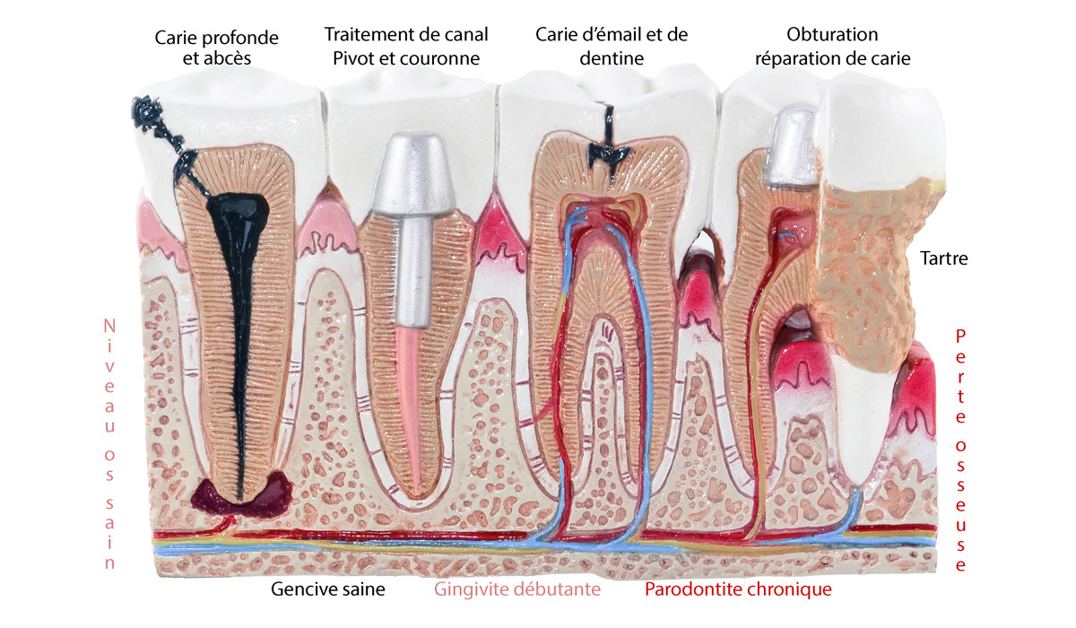 Traitement des dents
